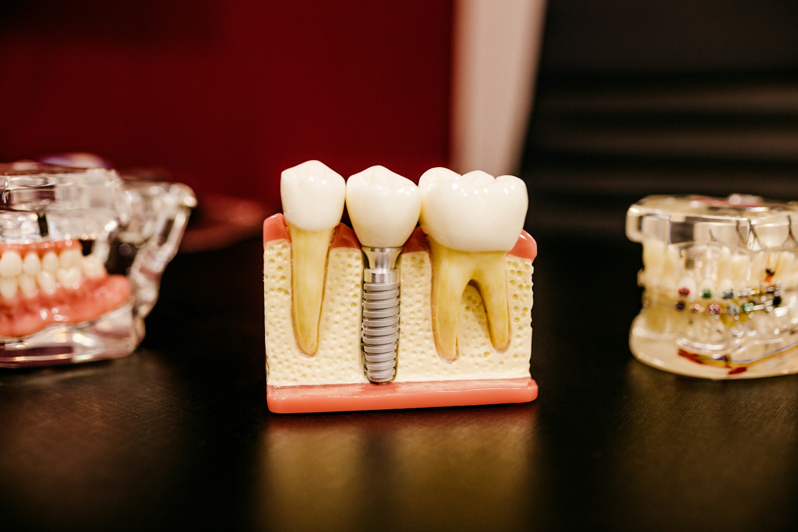 Ba mô hình hàm răng đặt trên bàn gỗ, ở giữa là mẫu cắt dọc cho thấy trụ implant chôn trong xương hàm